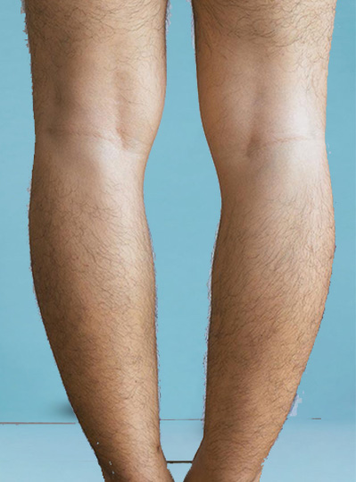 Knee Deformities